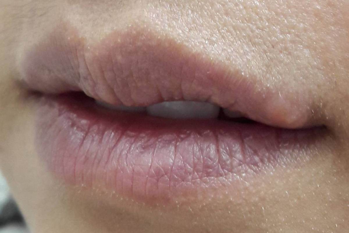 Imagem mostra boca com herpes