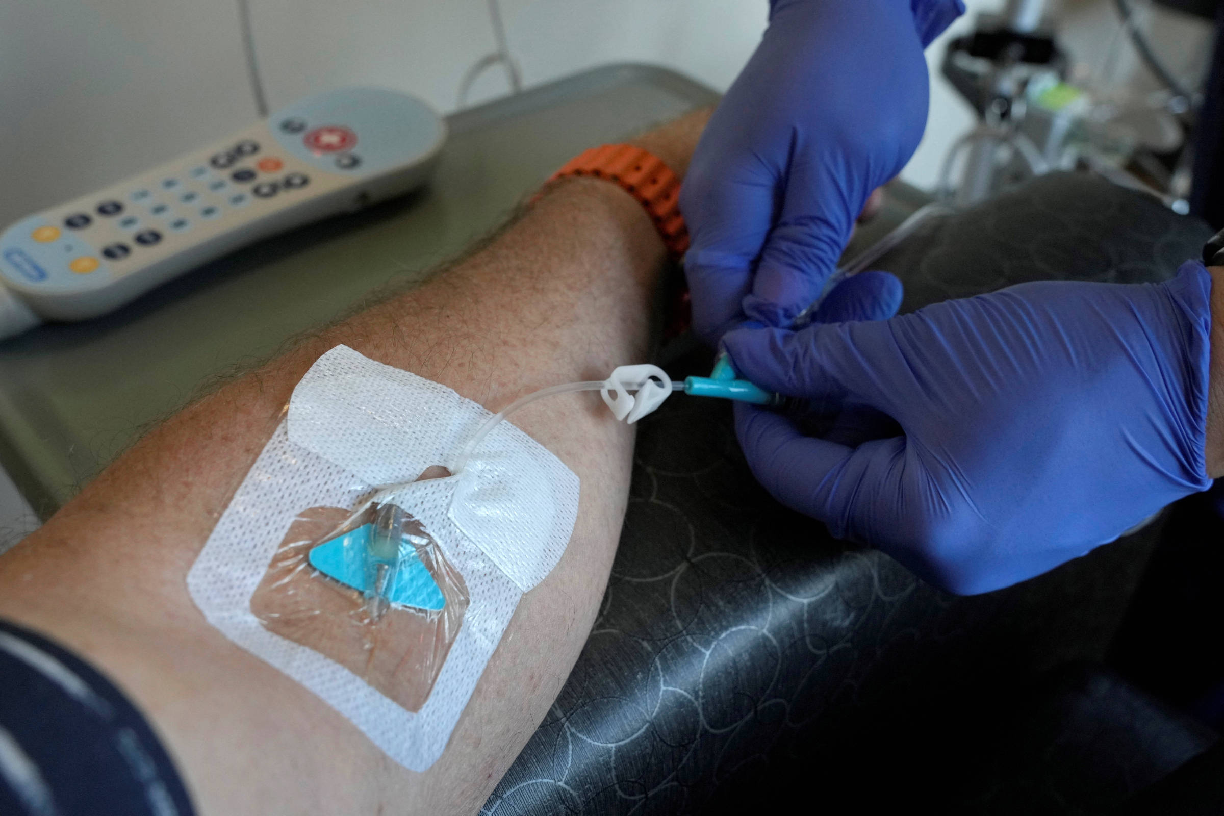 A imagem mostra um braço humano com um cateter intravenoso inserido. Um profissional de saúde, usando luvas azuis, está manipulando o cateter. Ao fundo, há um controle remoto e outros equipamentos médicos.