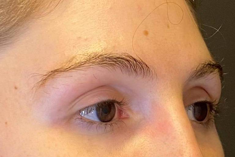 Entenda como funciona transplante de sobrancelhas - 04/06/2025 - Equilíbrio