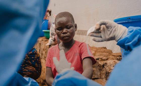 Casos de varíola M já atingem 25 países, 7 pela primeira vez