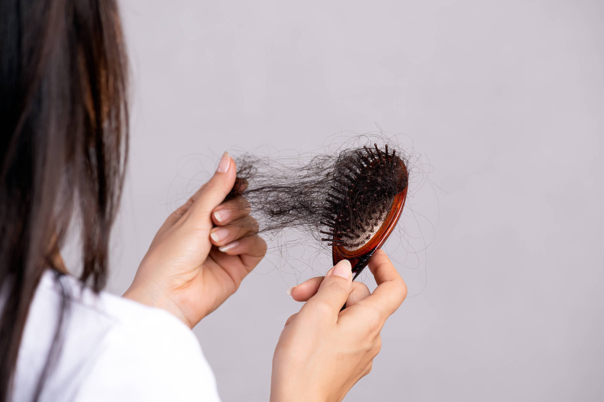 Alopecia areata: impacto psicológico supera perda capilar - 03/09/2025 - Equilíbrio