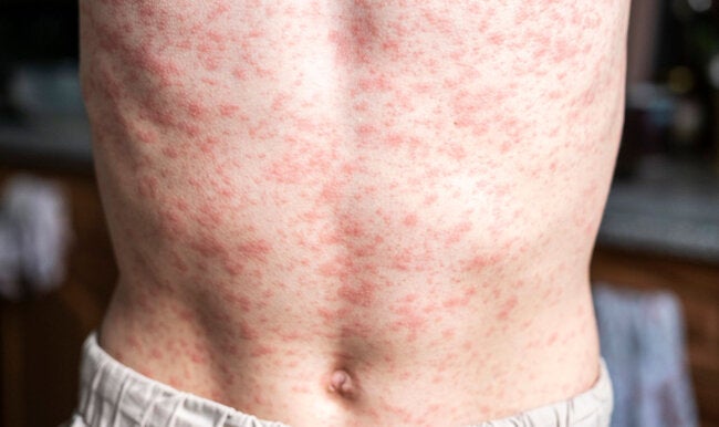 OPAS pede ação regional enquanto as Américas perdem status de eliminação do sarampo - OPAS/OMS