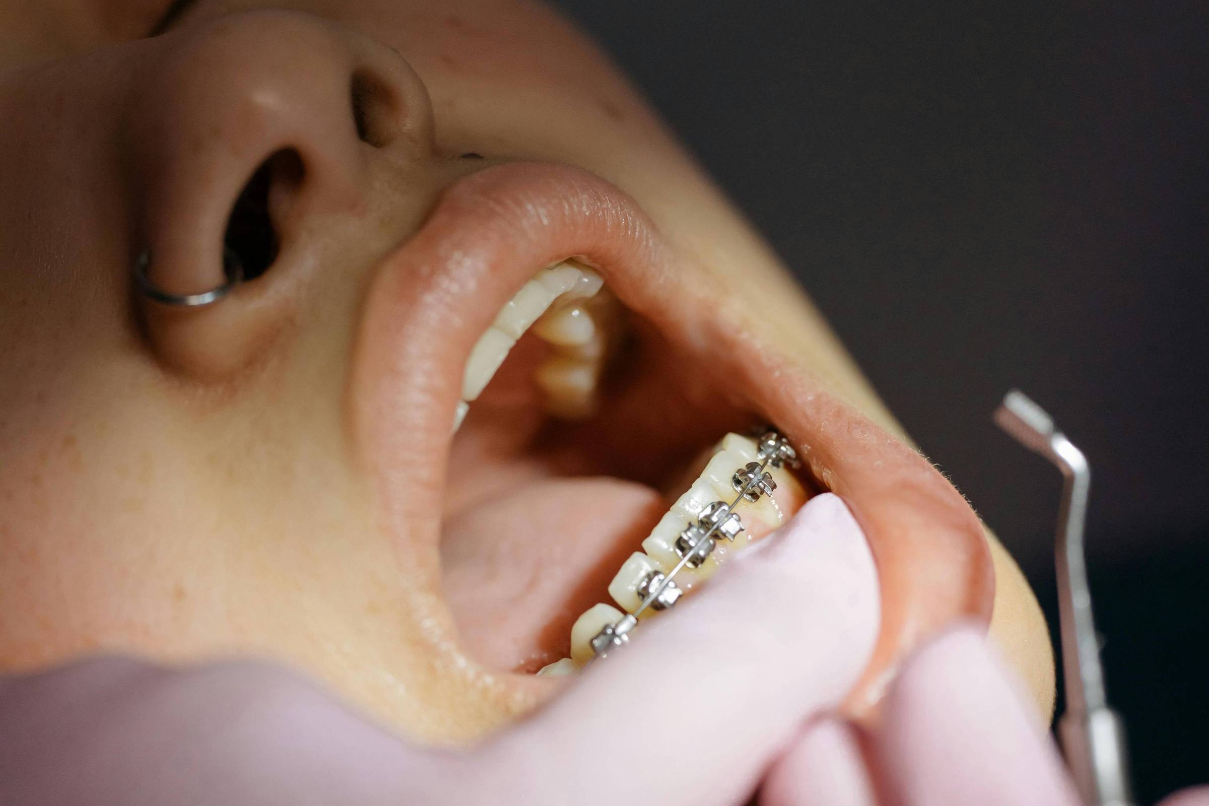 Paciente com aparelho ortodôntico nos dentes inferiores abre a boca durante exame odontológico. Mãos com luvas rosas seguram instrumento dental próximo aos dentes.
